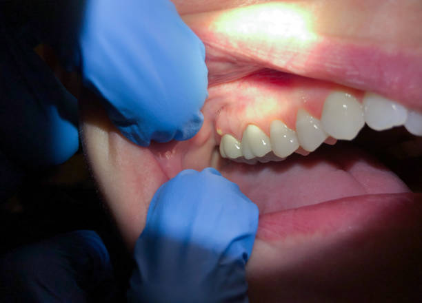 Best Broken or Chipped Tooth Repair in Wakefield, KS